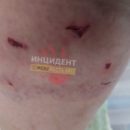 Омичка показала последствия жестокого нападения собаки